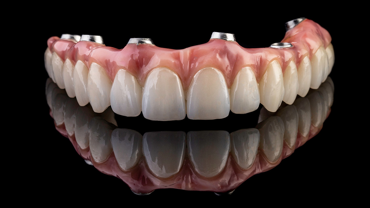 Dental Implants by Dr. Cantú Davis _ Nogales, Mexico