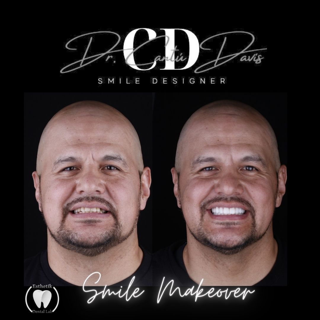 Smile Makeover by Dr. Cantú Davis - Nogales Root Canal & Dental Implants Specialist