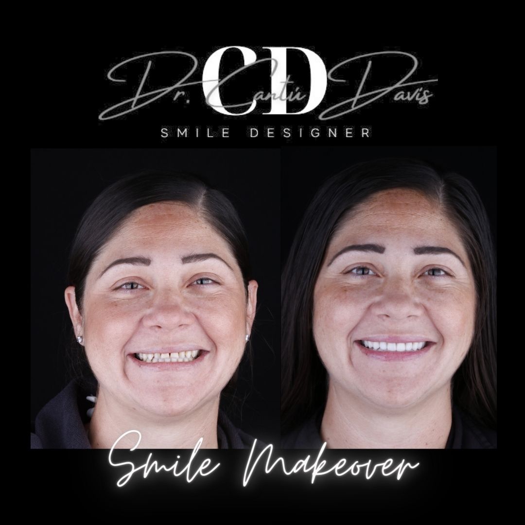 Smile Makeover by Dr. Cantú Davis _ Nogales, Mexico